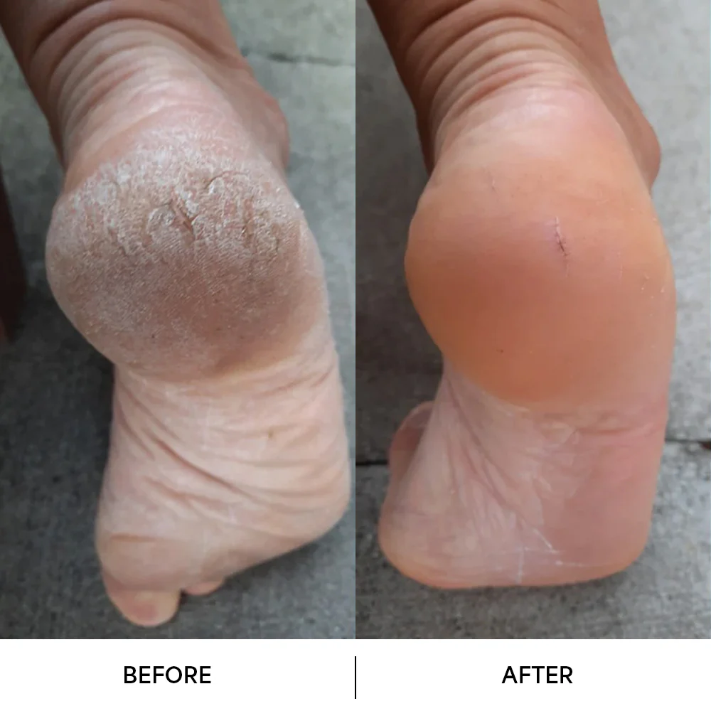 HeyGirl™ Electric Foot Callus Remover